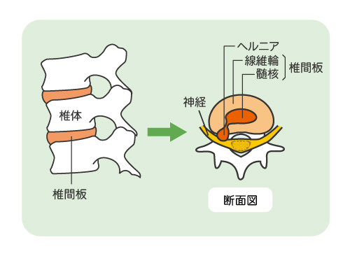 強い腰の痛みヘルニアに。PED手術、ヘルニコアの治療 | 岡山旭東病院