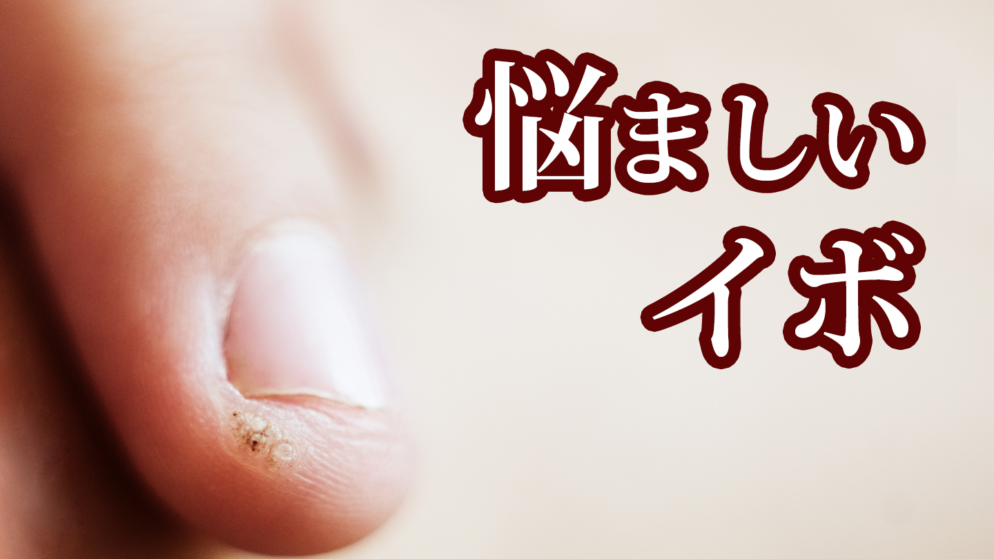 冷凍治療にはコツがある【ウイルス性イボ】｜たかはし皮膚科